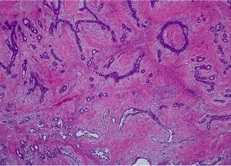 Cureus Bilateral Concurrent Benign Phyllodes Tumor In A 43 Year Old