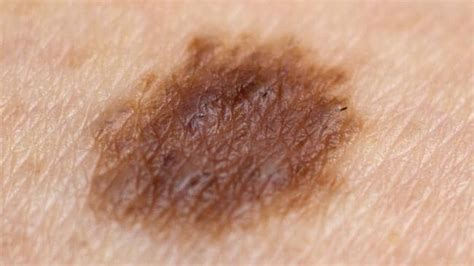Skin Cancer Check Number Of Moles On Your Right Arm An Indicator Of
