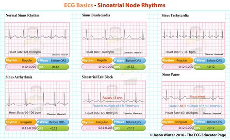 Ecg Educator Blog Sinoatrial Node Rhythms