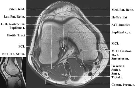 Injuries of the patellofemoral joint. Supplemental Materials for Normal MR Imaging Anatomy of ...