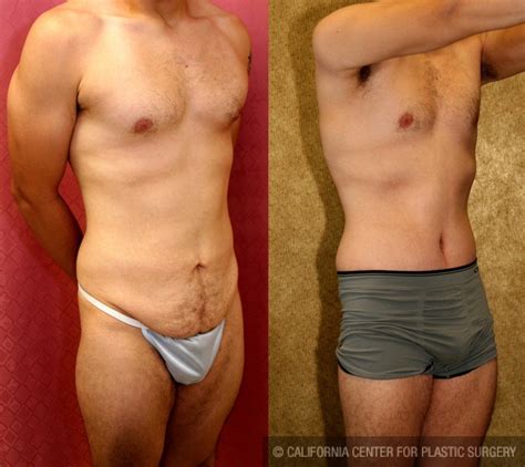Patient Male Tummy Tuck Abdominoplasty Before And After Photos