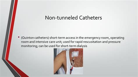 Quinton Catheter