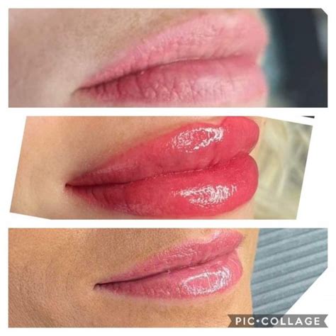 candy lips before and after