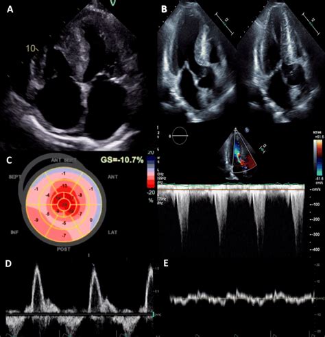 Echocardiographic Features Of Cardiac Amyloidosis A Apical 4 Chamber