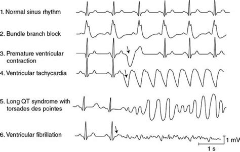 Cardiac Abnormalities Cardiovascular Physiology 9th Ed