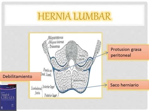 Hernias Pared Abdominal Anterolateral Y Lumbar Ppt