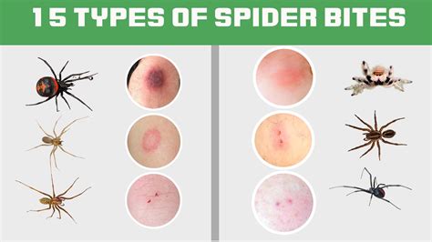 15 Types Of Spider Bites Identification Chart With Picture