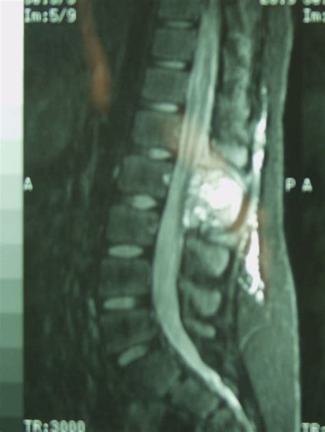 Aneurysmal Bone Cyst Spine 9yo