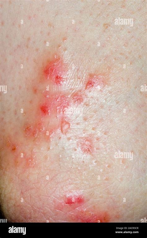Close Up Of Red And Inflamed Skin On The Elbow Of A 49 Year Old Female