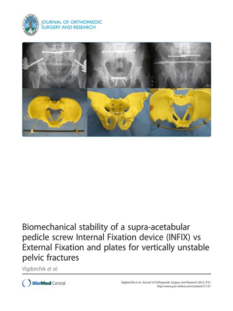 Pdf Biomechanical Stability Of A Supra Acetabular Pedicle Screw