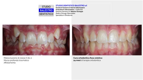 Studio Dentistico Balestro Malocclusione Di Ii Classe Div