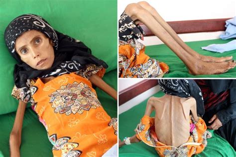 Heartbreaking Pics Of Girl 12 Reduced To Skin And Bones As Brutal