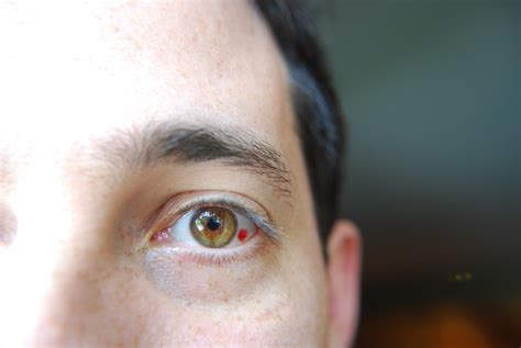 Burst Blood Vessel Eye Causes And Treatment Wealth Fits