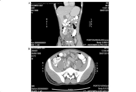 A And B Views Ct Scan Of The Abdomen And Pelvis Showing An Abnormal