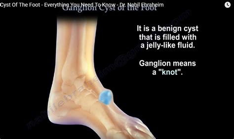 Ganglion Cyst Of The Foot —