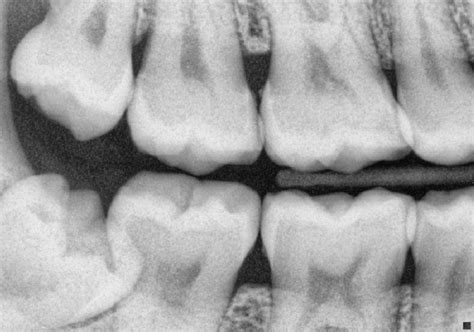 Bitewing Dental X Rays News Dentagama