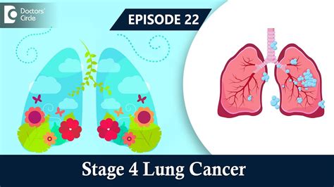 Stage 4 Lung Cancer Symptoms Treatment Life Expectancy Dr Suresh Babu And Dr Nisha Vishnu
