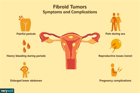 31 Uterine Fibroids Signs And Symptoms