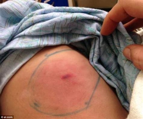 Symptoms of a spider bite are pain, irritation, and redness. Mother Shares Photos Of Fatal Spider Bite That Took Her 5 ...
