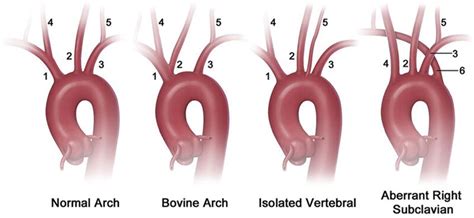 Aortic Arch Anomalies Brachiocephalic Artery Left Common