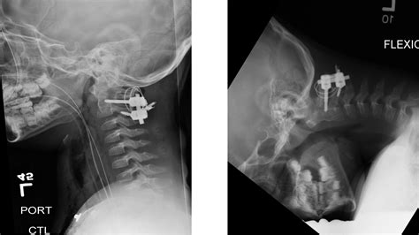 Cureus Cervical Pediatric Spine Trauma Managed With Open Spinal