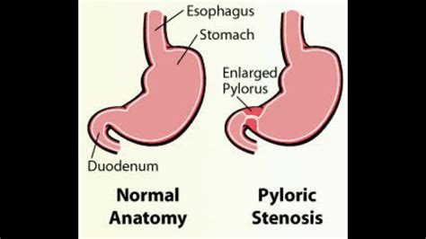 Congenital Hypertrophic Pyloric Stenosis 1 Youtube