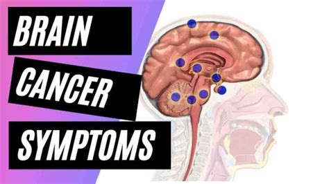 17 Brain Cancer Symptoms To Watch Out For 2023
