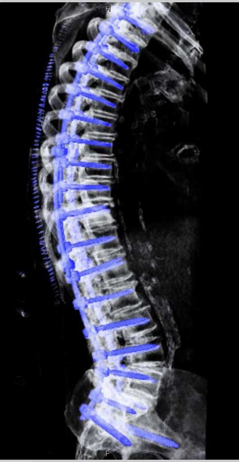 Spinal Repair With Color Coded Hardware Musculoskeletal Case Studies