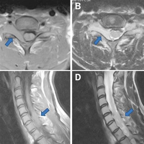 T1 And T2 Weighted Axial Mri Of The Cervical Spine Showed An Eden Type
