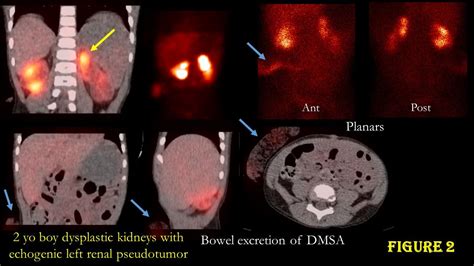 Hybrid Imaging With Spect Ct And Spect Mr In Renal Scintigraphy