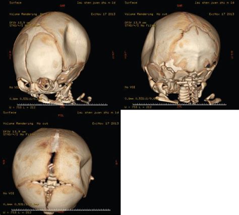 Congenital Skull Depression In A Newborn Delivered By Cesarean Section