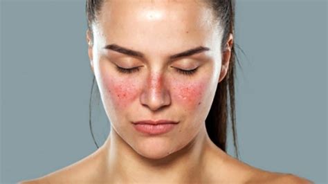 10 Early Signs Of Lupus Things Health