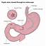 Gastric Ulcer  Healthcare Blog Article By Dr O