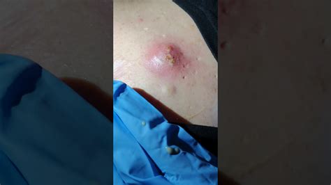 Best Pipple Pop Of EXPLODING Spot Pimple Cyst Popping Pimple Popping Videos