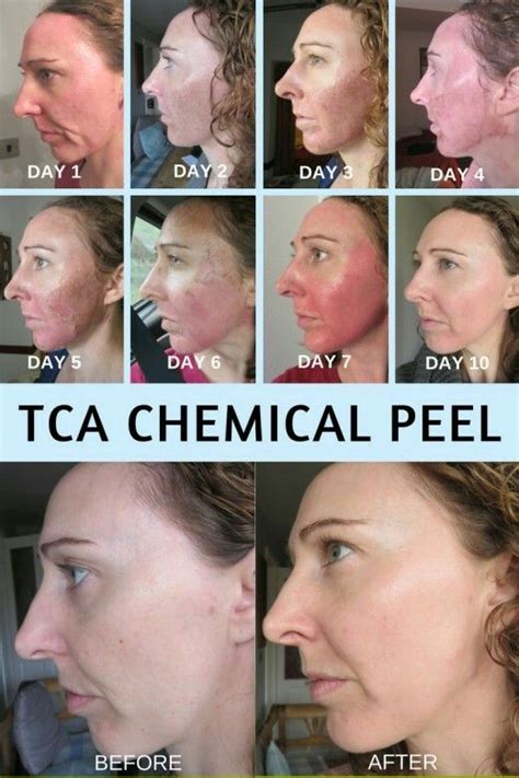 You should always wait for your body to heal after receiving a tca peel before getting another. Pin on Stay beautiful