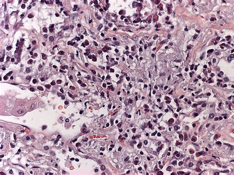 Benign Lymphoproliferative Disorders Of The Lung Benign