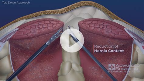 Racgp A Gp Primer On Incisional Hernia Porn Sex Picture