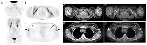 Imaging Characteristics Of Adult Onset Still S Disease Demonstrated With F FDG PET CT