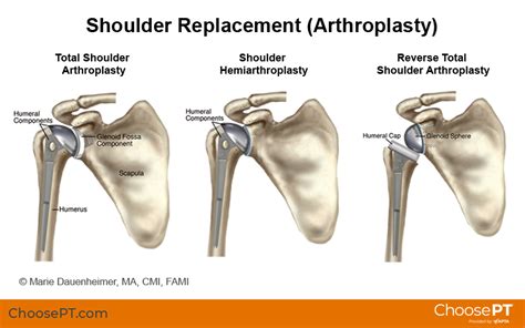 What To Expect With Shoulder Replacement Surgery
