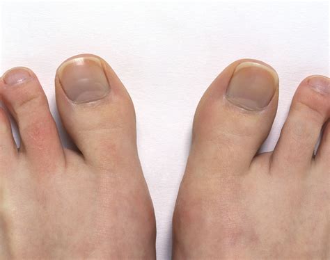 Symptoms Of Arthritis Of The Big Toe Hallux Rigidus