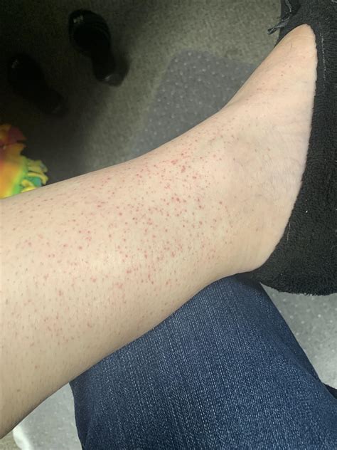 What Is This These Red Spots Will Randomly Show Up On Both Ankles