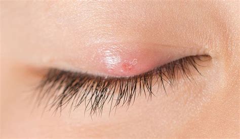 Eyelid Bumps Are Red Pimple Like Lumps That Are Usually Harmless And