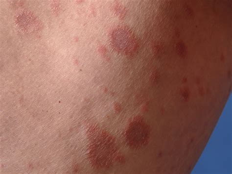 Pityriasis Rosea Pictures
