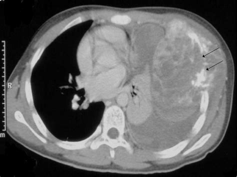 A Contrast Enhanced Ct Examination Of The Chest Showing A Large
