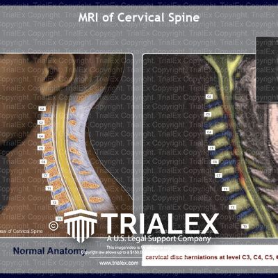Mri Of Cervical Spine Trialexhibits Inc Free Hot Nude Porn Pic Gallery