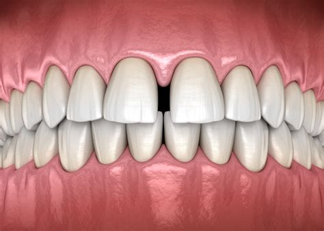 Gapped Teeth These Are Your Treatment Options Twentyonedental