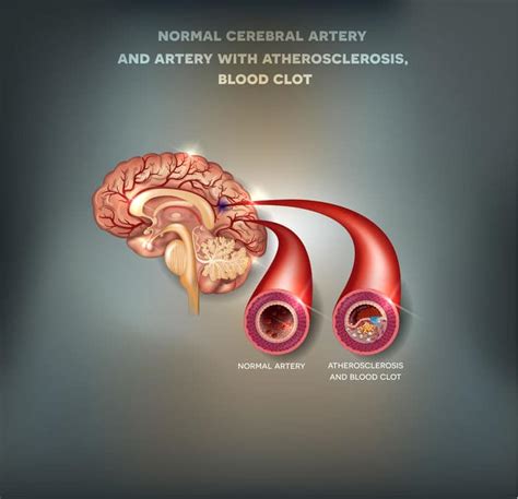 Stroke Cerebrovascular Accident Symptoms Treatment And Prevention At