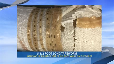 Fresno Man Pulls Out A 5 Foot Tapeworm While On The Toilet Wsyx