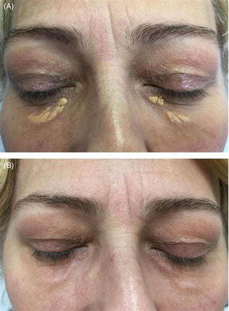 Long‐wave Plasma Radiofrequency Ablation For Treatment Of Xanthelasma