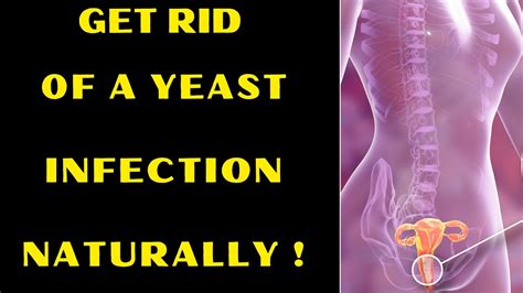 How To Cure A Yeast Infection At Home Fast With Natural Remedies Youtube